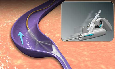 ClariVein | Ambulance cévní chirurgie Tábor
